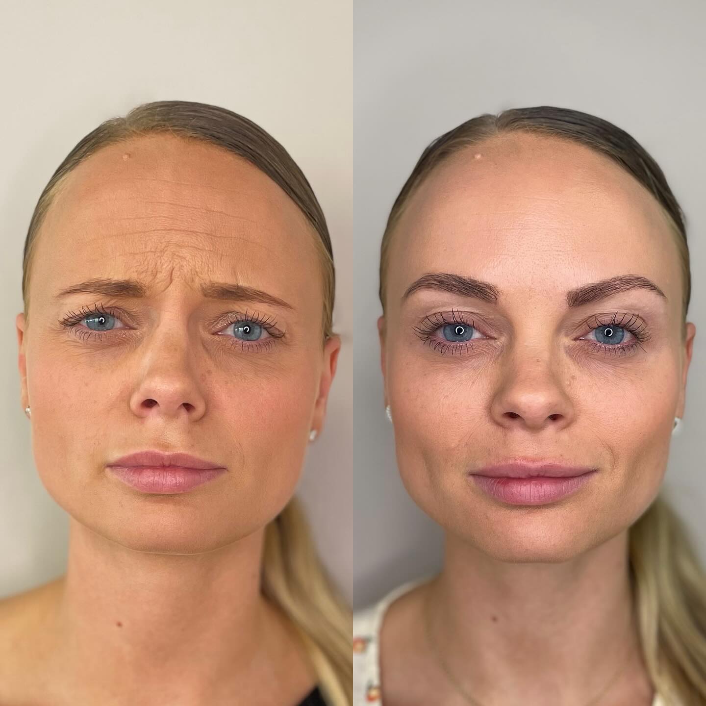 botox