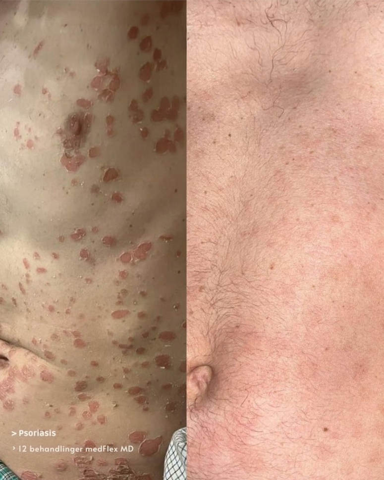 MandPsoriasis